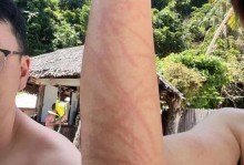 水母蛰伤的症状和处理方法（水母蛰伤对人体的影响及应急处理方法）